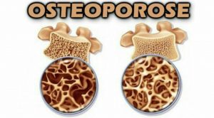 پوکی استخوان