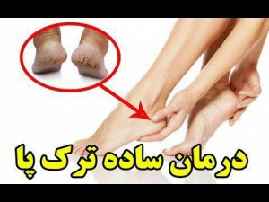 آشنایی با ۸ درمان خانگی موثر برای رفع ترک پا