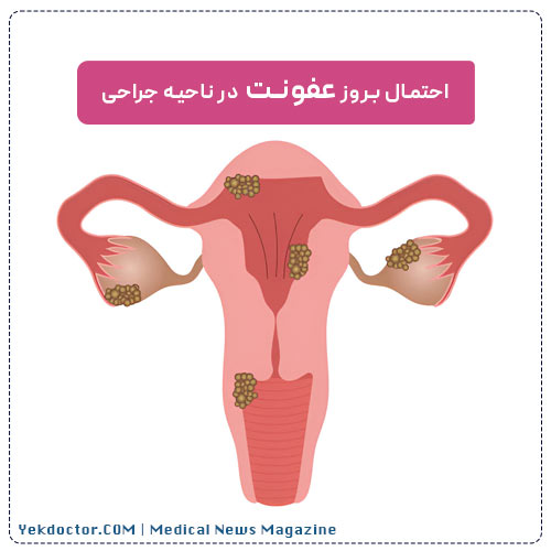 عفونت و التهاب واژن پس از هایمنوپلاستی