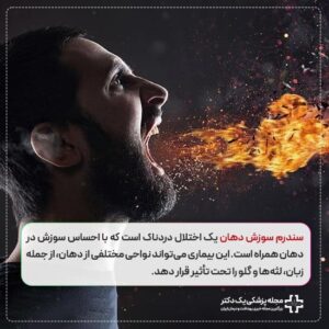 سندرم سوزش دهان