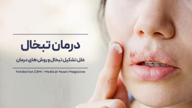 راهکارهای خانگی درمان تبخال