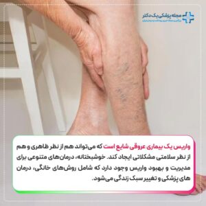 درمان واریس