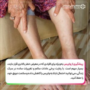 پیشگیری از واریس