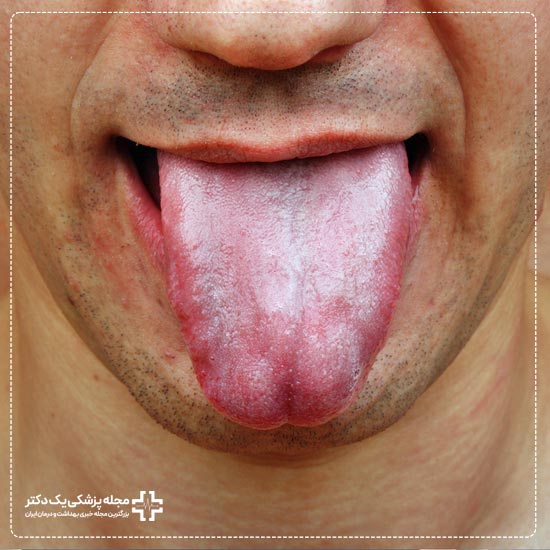 درمان خانگی سوختگی زبان