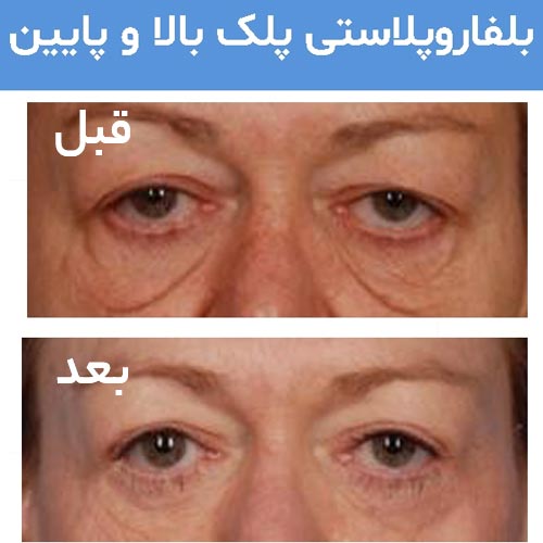 قبل و بعد از جراحی پلک