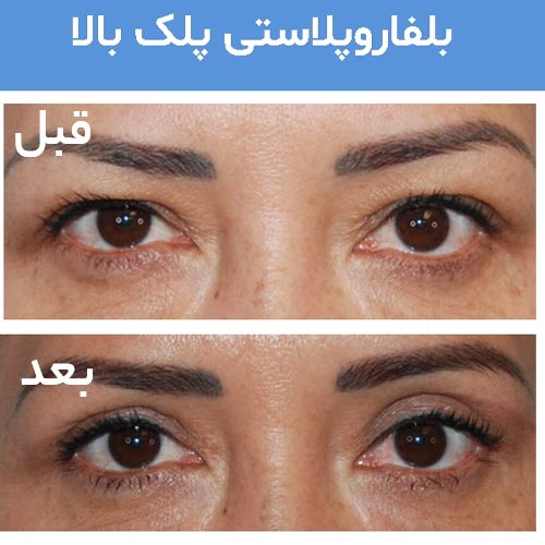 قبل و بعد از جراحی پلک