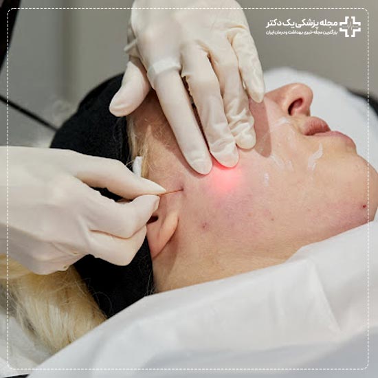 اندولیفت صورت