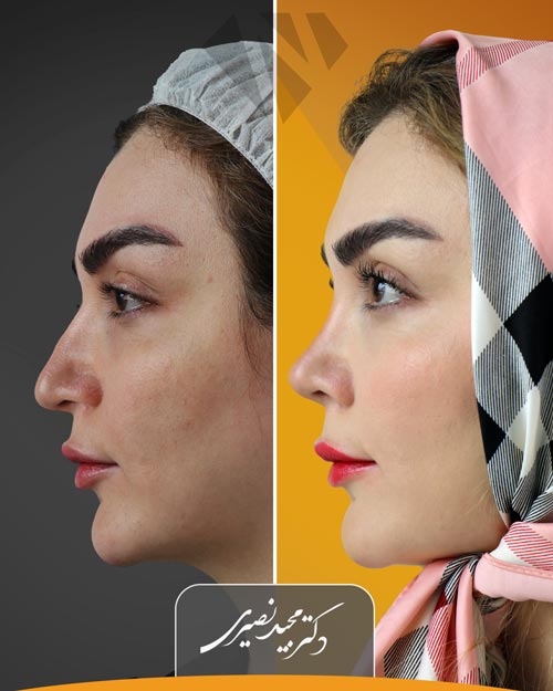 نمونه جراحی بینی انجام شده در کلینیک زیبایی نورسا توسط دکتر مجید نصیری