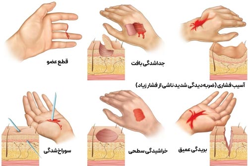 انواع زخم در کلینیک زخم سلامت
