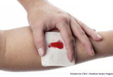 درمان عفونت زخم