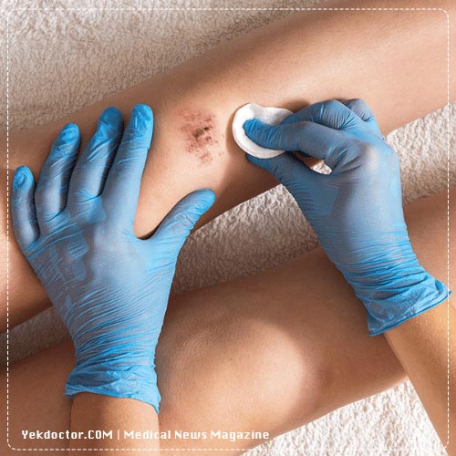 ضدعفونی زخم